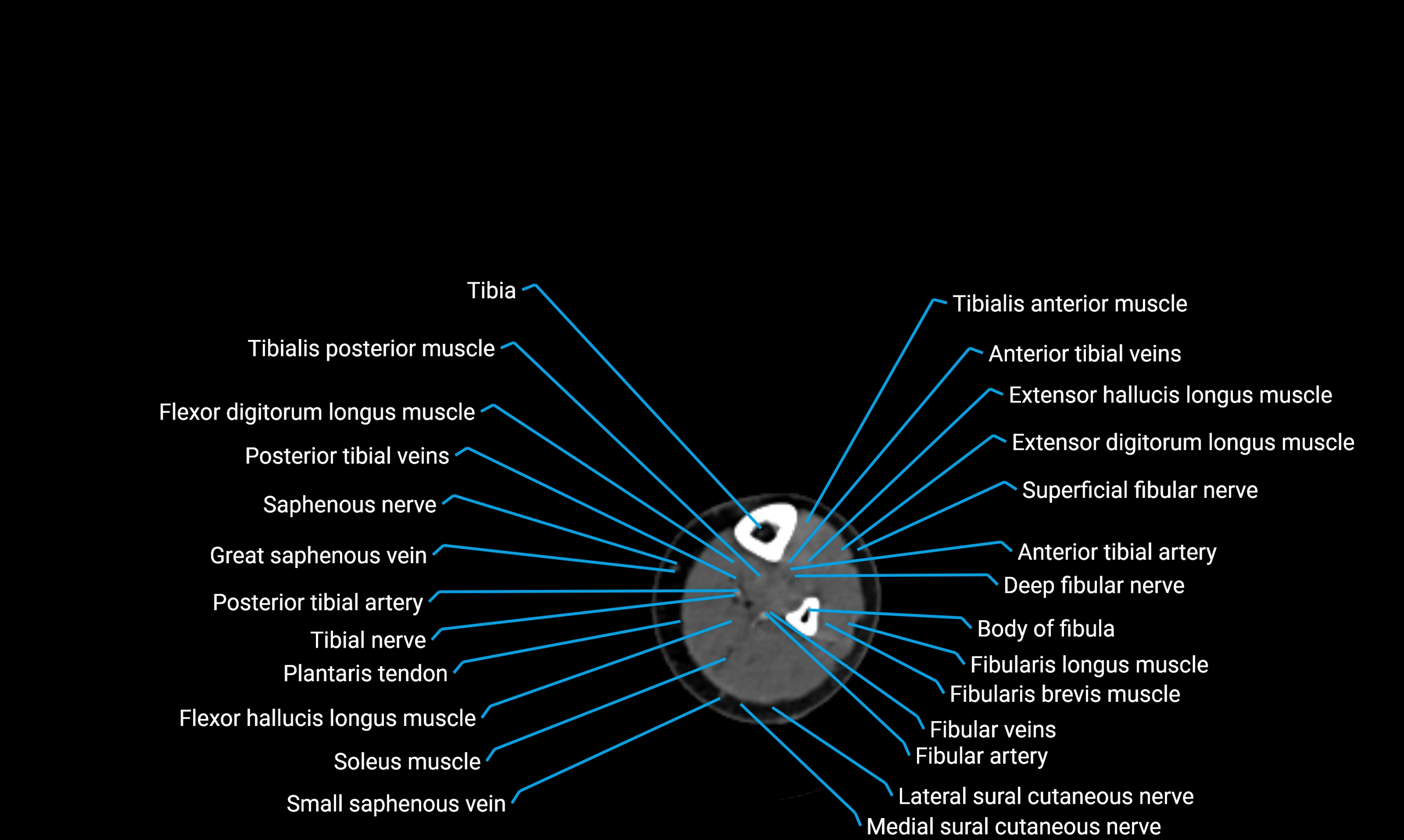CT lower limb axial cross sectional anatomy labelled image 132 (2).webp